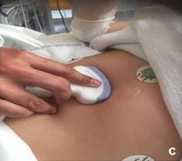 Sondenpositionierung subxiphoidal zur Untersuchung des Perikards