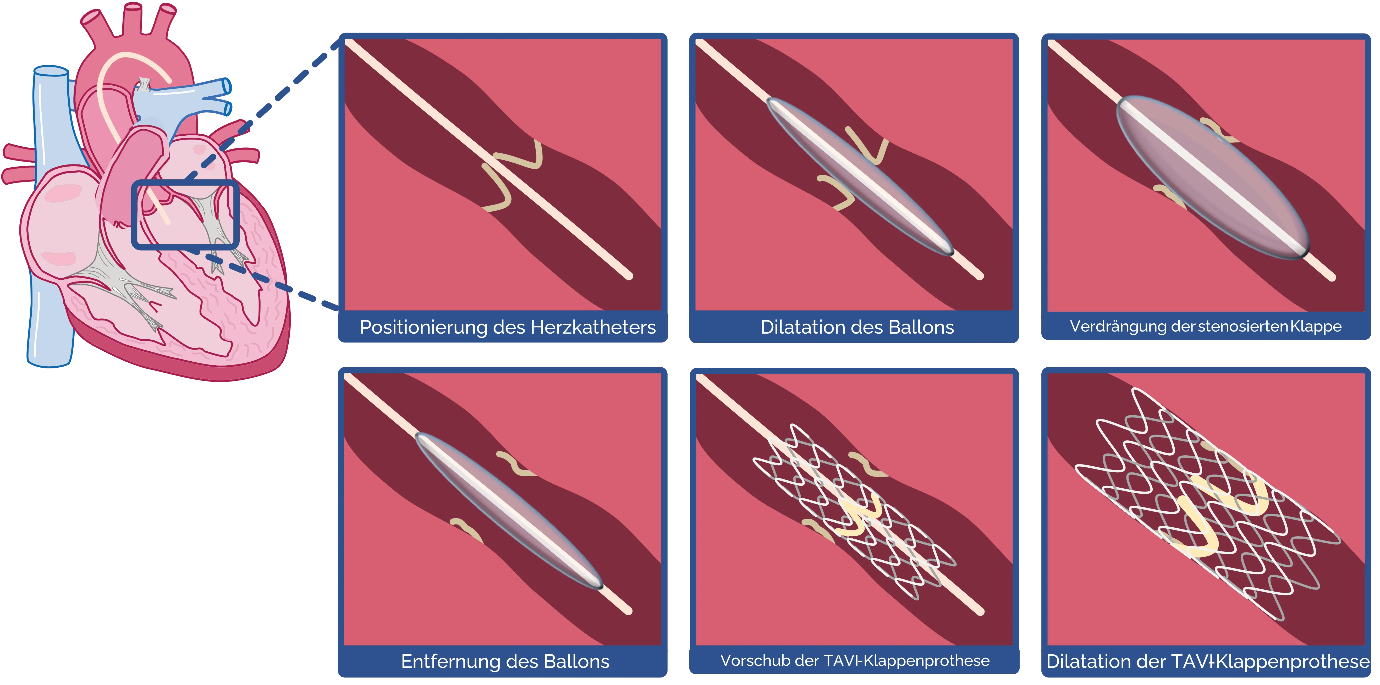 Transfemoraler Aortenklappenersatz (= TAVI)