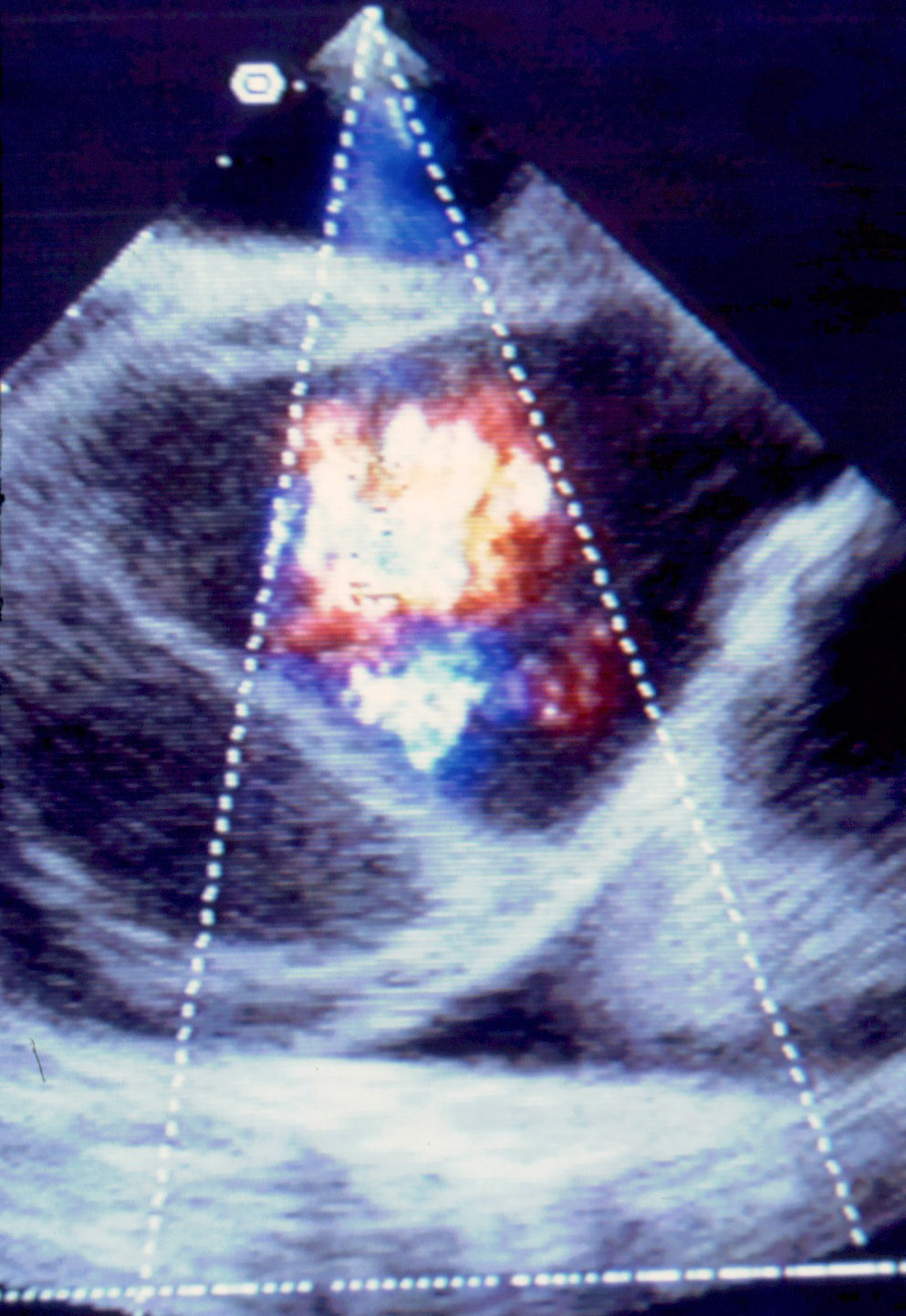 Transösophageale Echokardiographie (TEE) mit Farbdoppler bei einer Aortendissektion