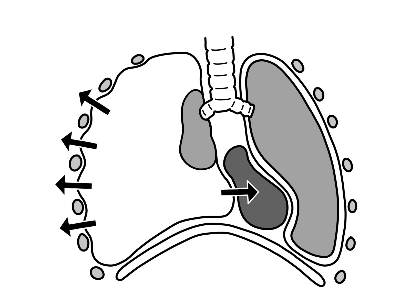 Kompression des Mediastinalraums