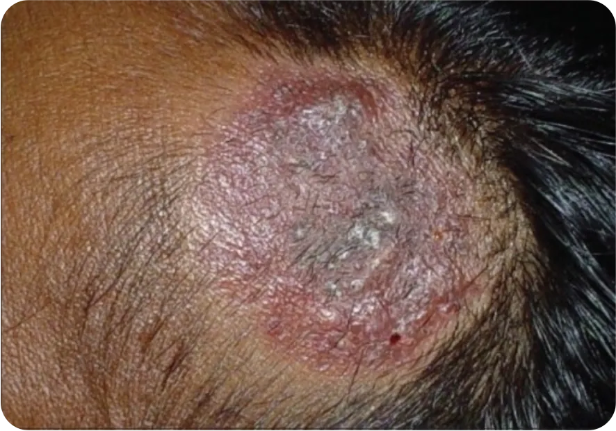 Tinea capitis profunda