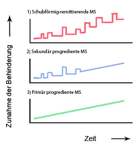 Klinische Verlaufsformen der MS