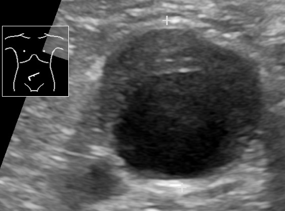 Ultraschall: abdominelles Aortenaneurysma