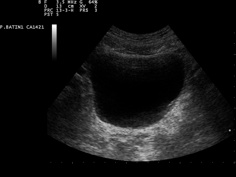 Ultraschallaufnahme einer gefüllten Harnblase im Querschnitt