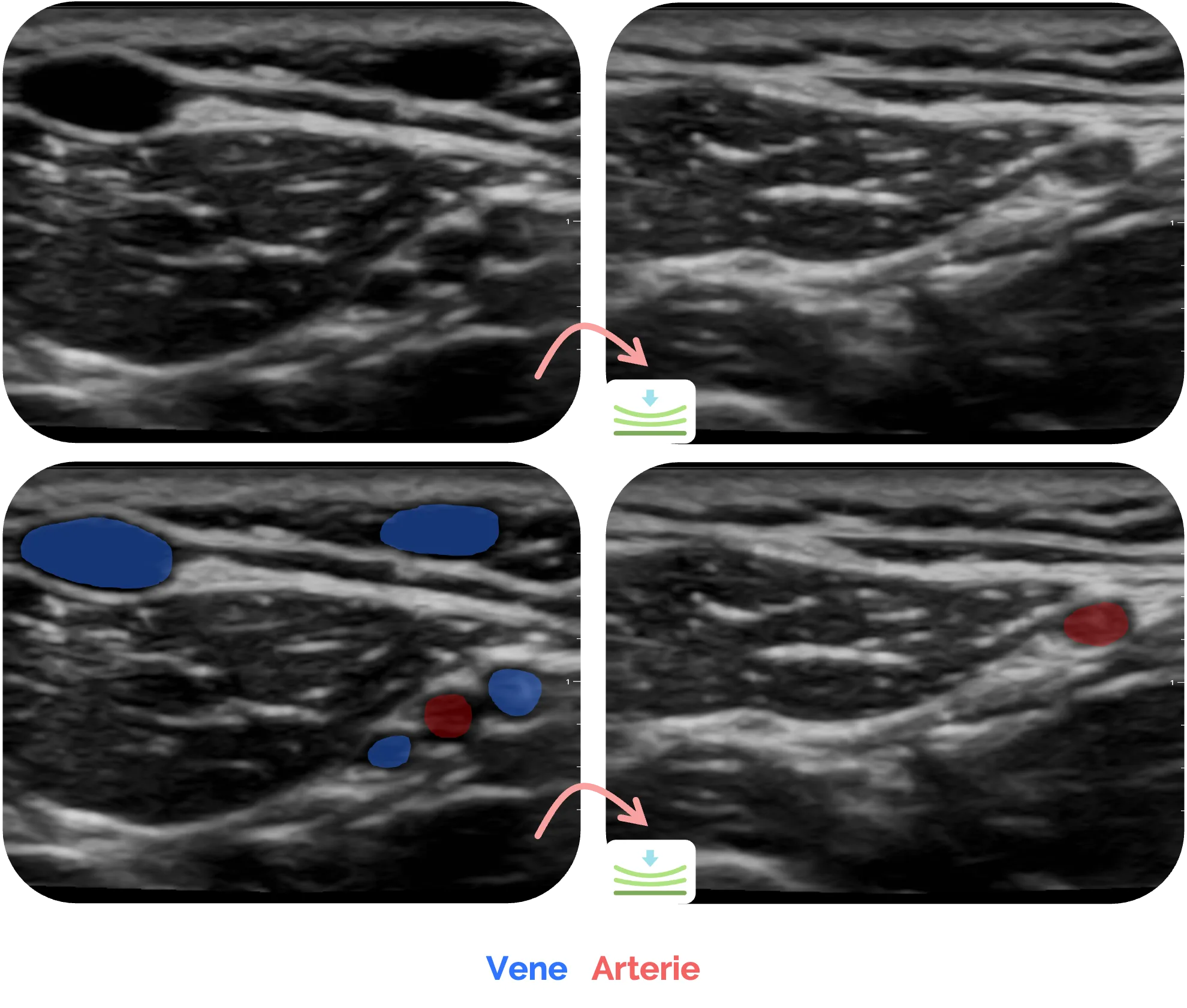 Sonographie: Venen und Arterien während der Kompression