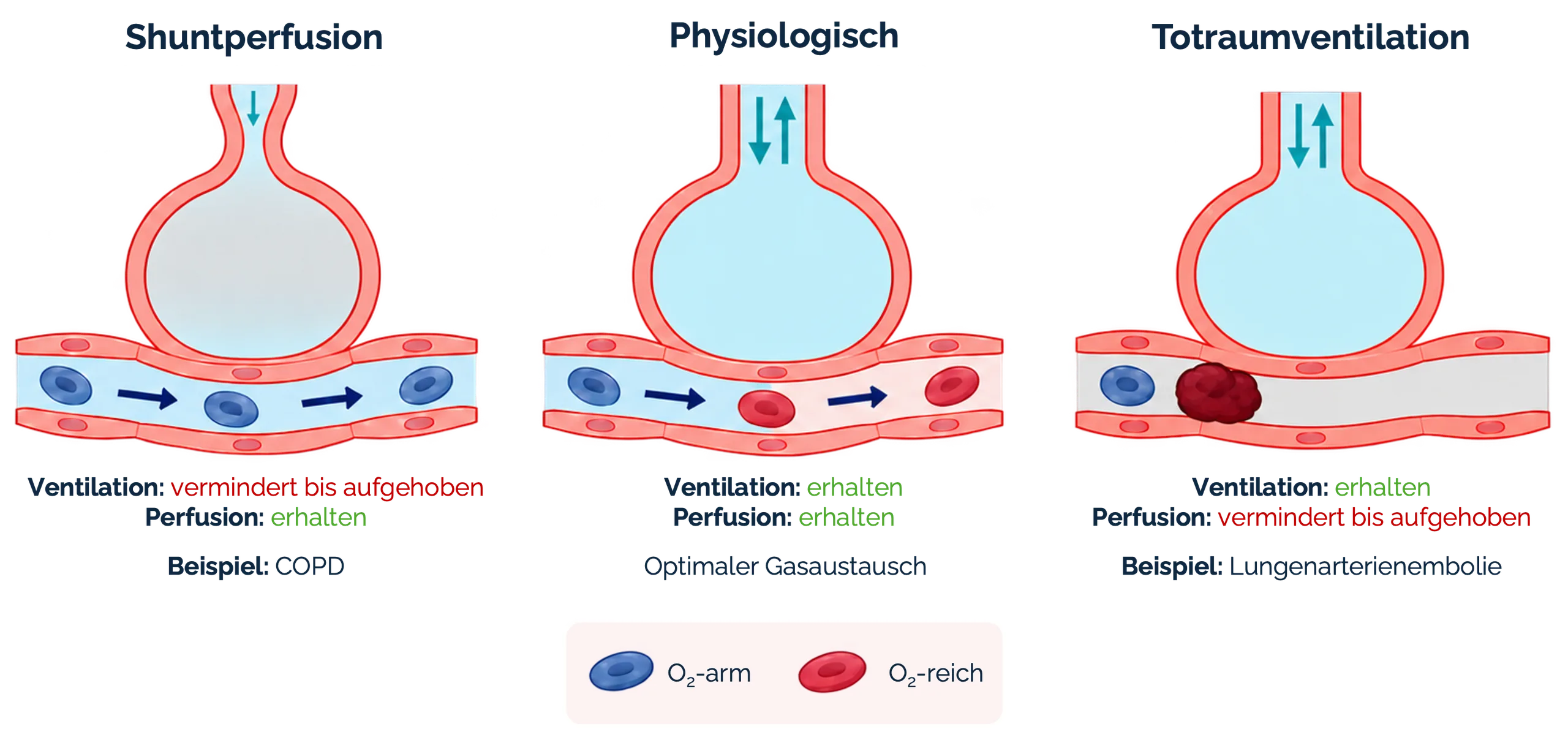 Ventilations-Perfusions-Verhältnis
