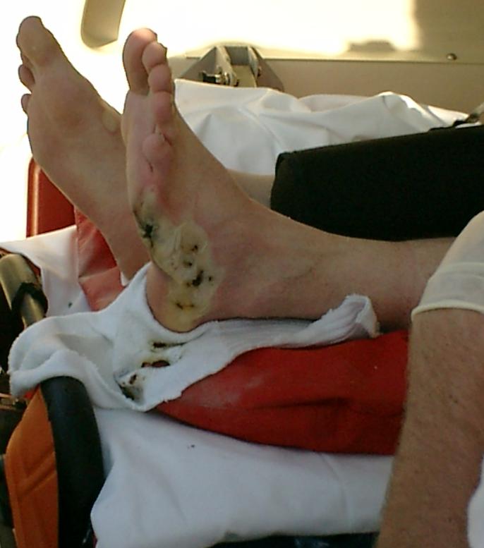 Verbrennung nach Hochspannungsunfall