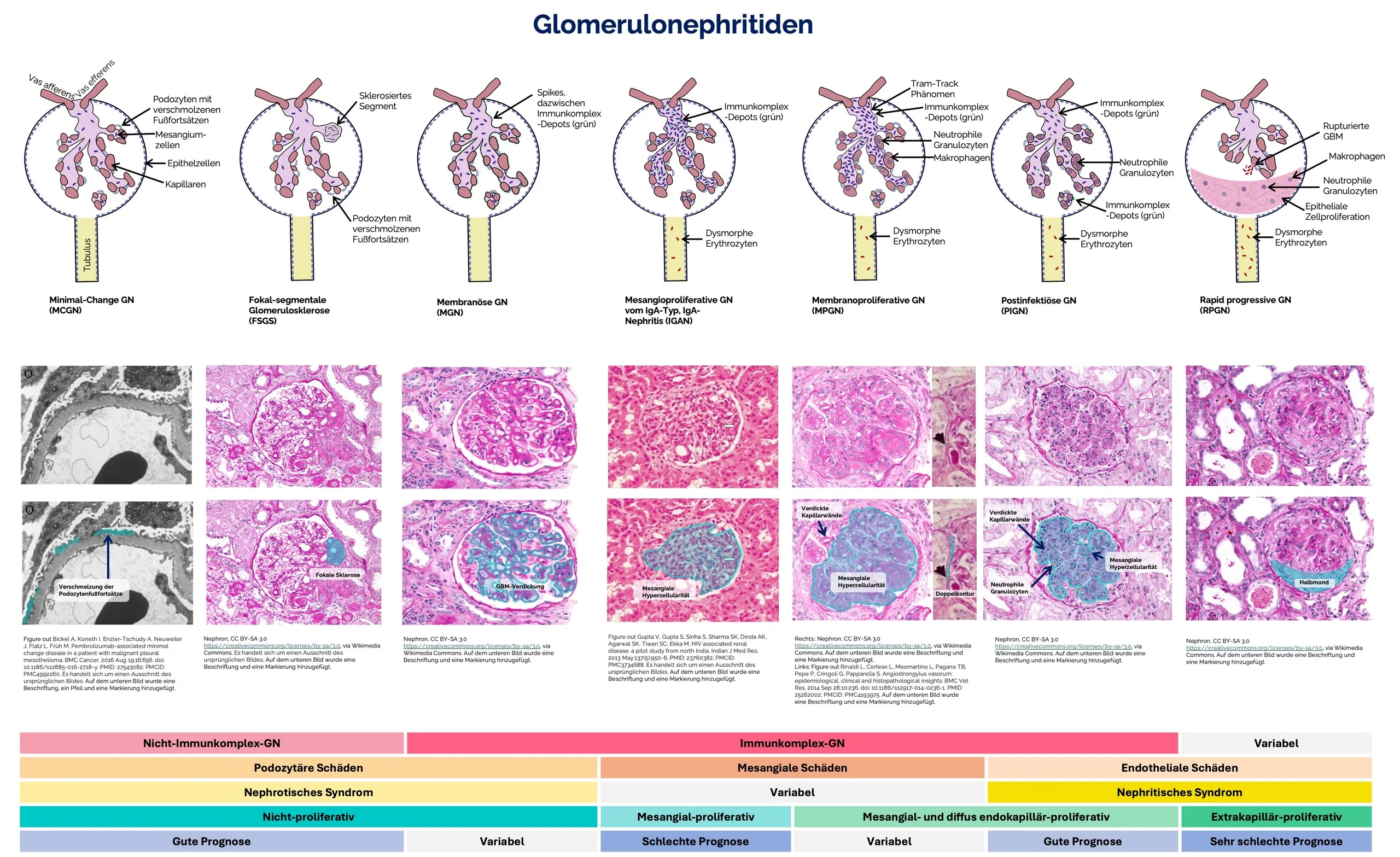 Vergleich Glomerulonephritiden