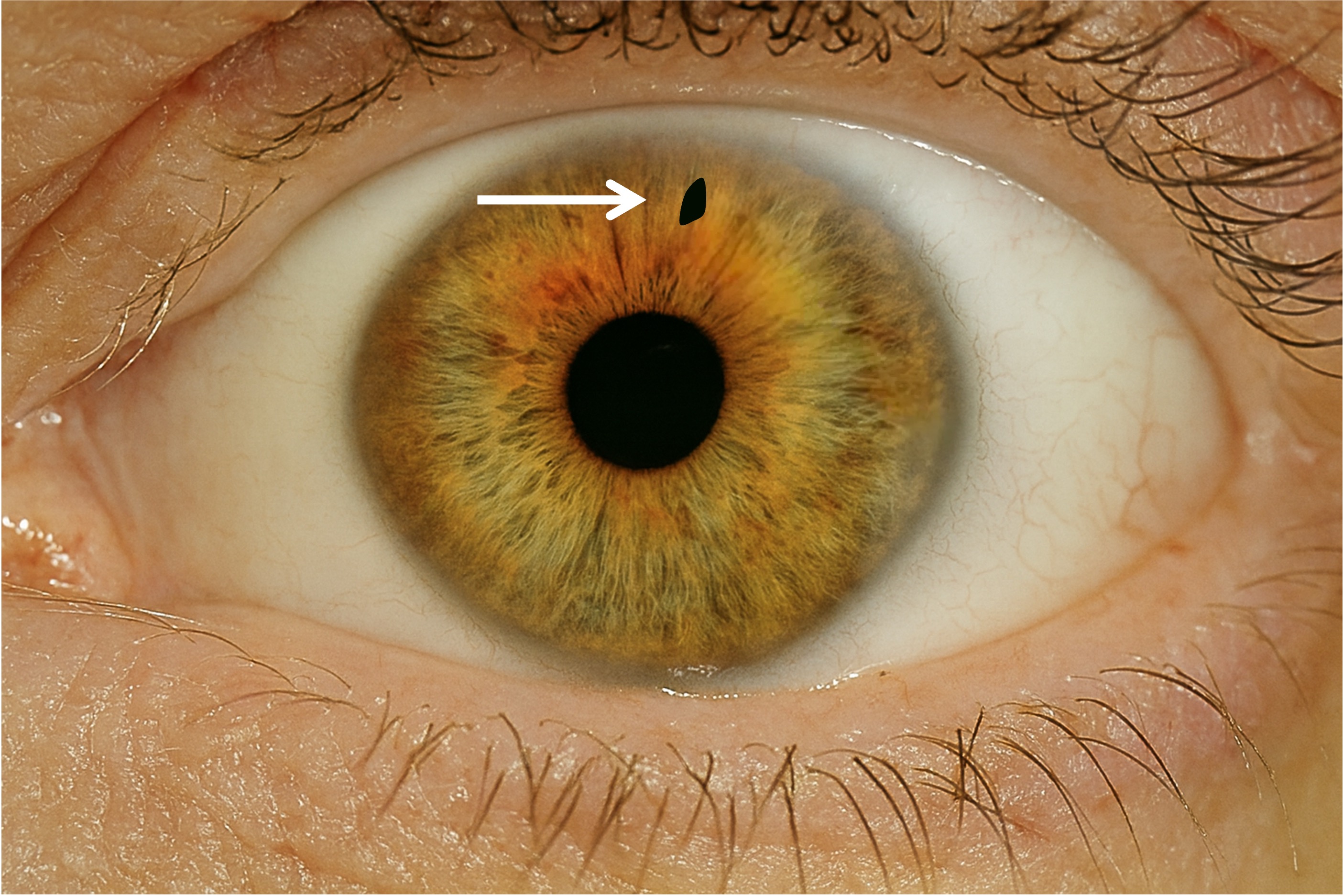 YAG-Laser-Iridotomie bei akutem Winkelblock