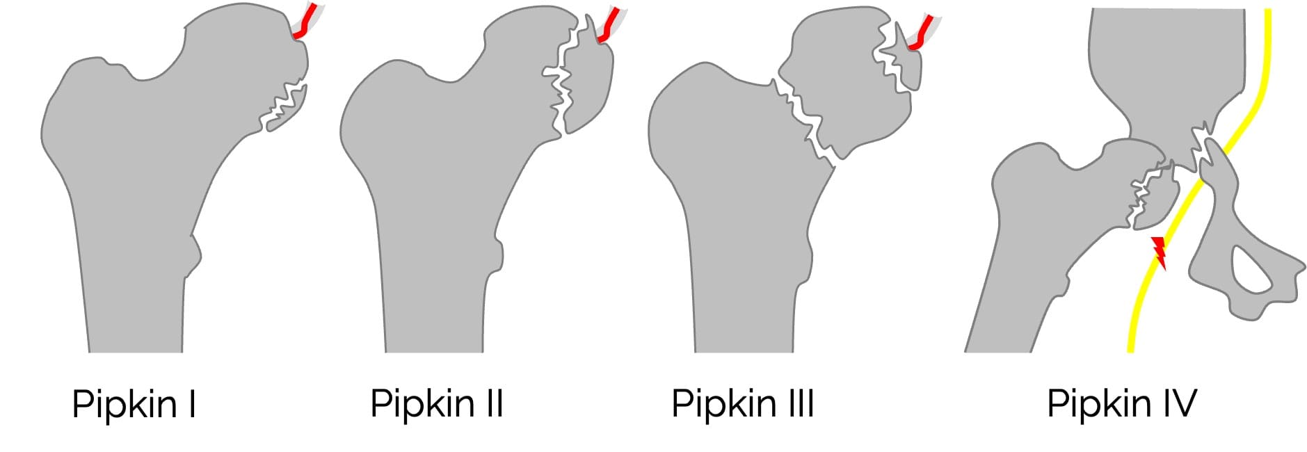 Pipkin-Klassifikation