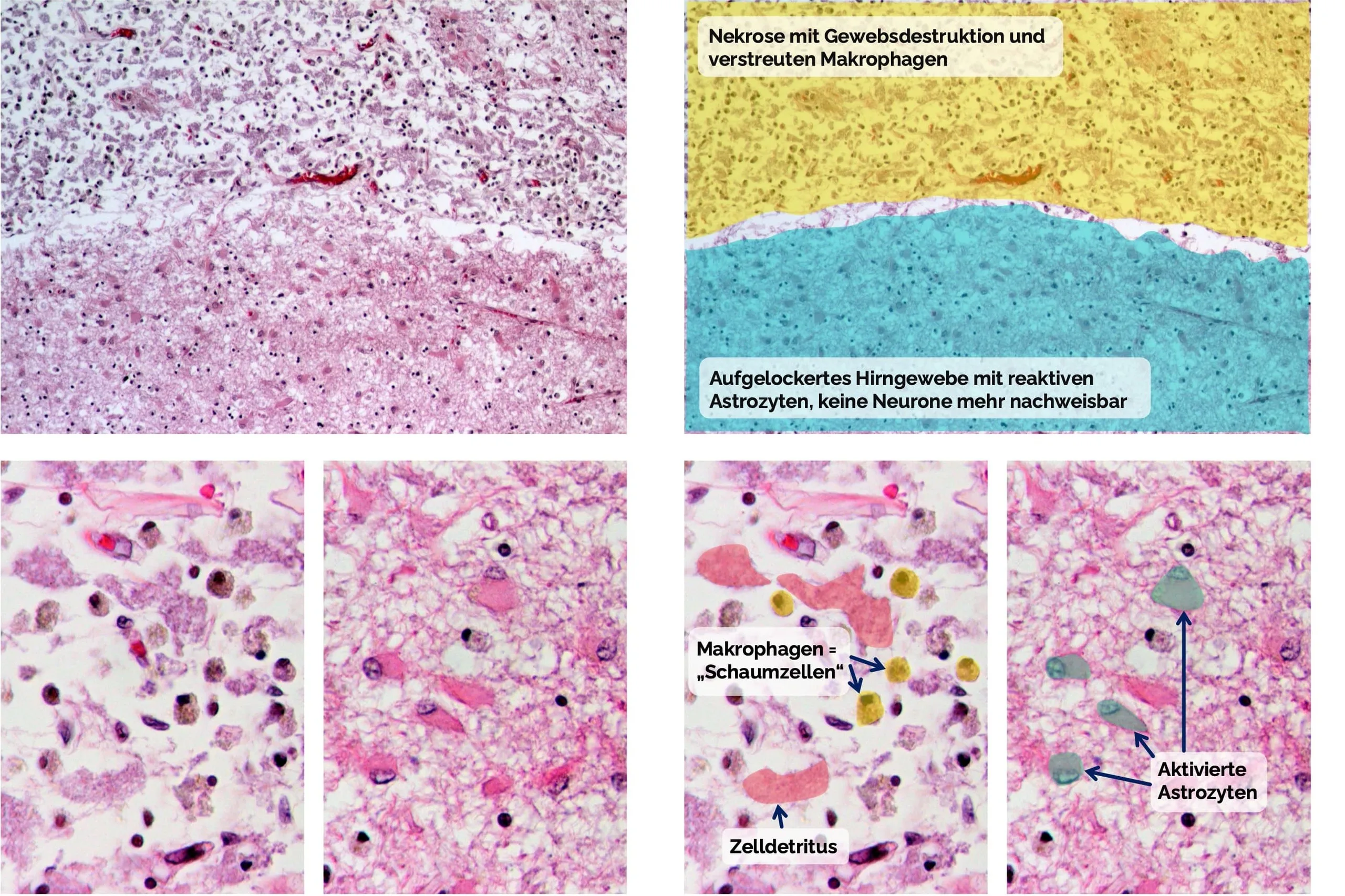 Histologie bei älterem zerebralen Infarkt
