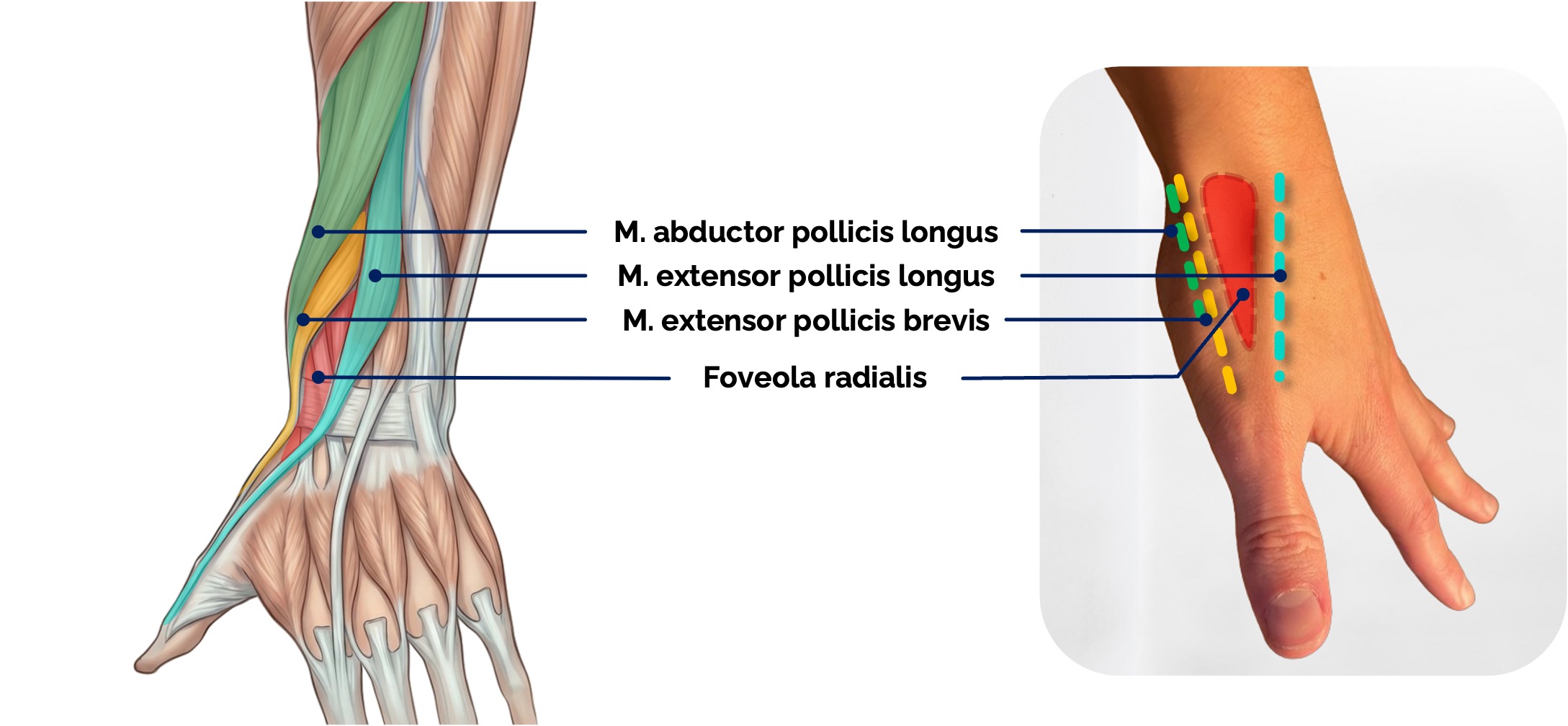 Foveola radialis (= Tabatière)