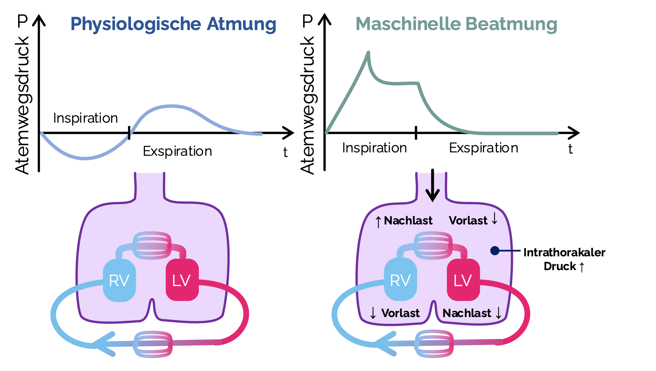 Vergleich von physiologischer Atmung und maschineller Beatmung