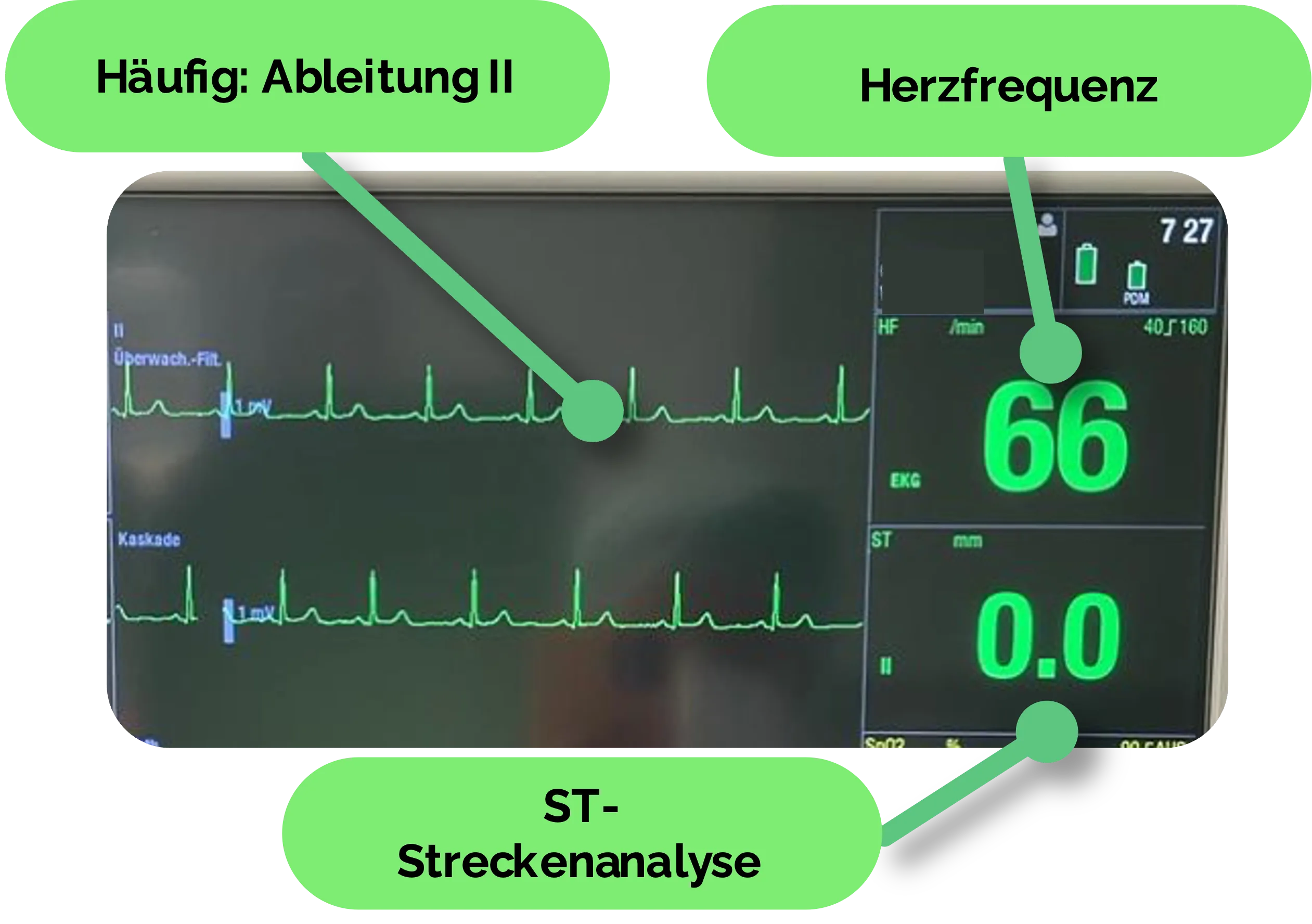 Monitor EKG