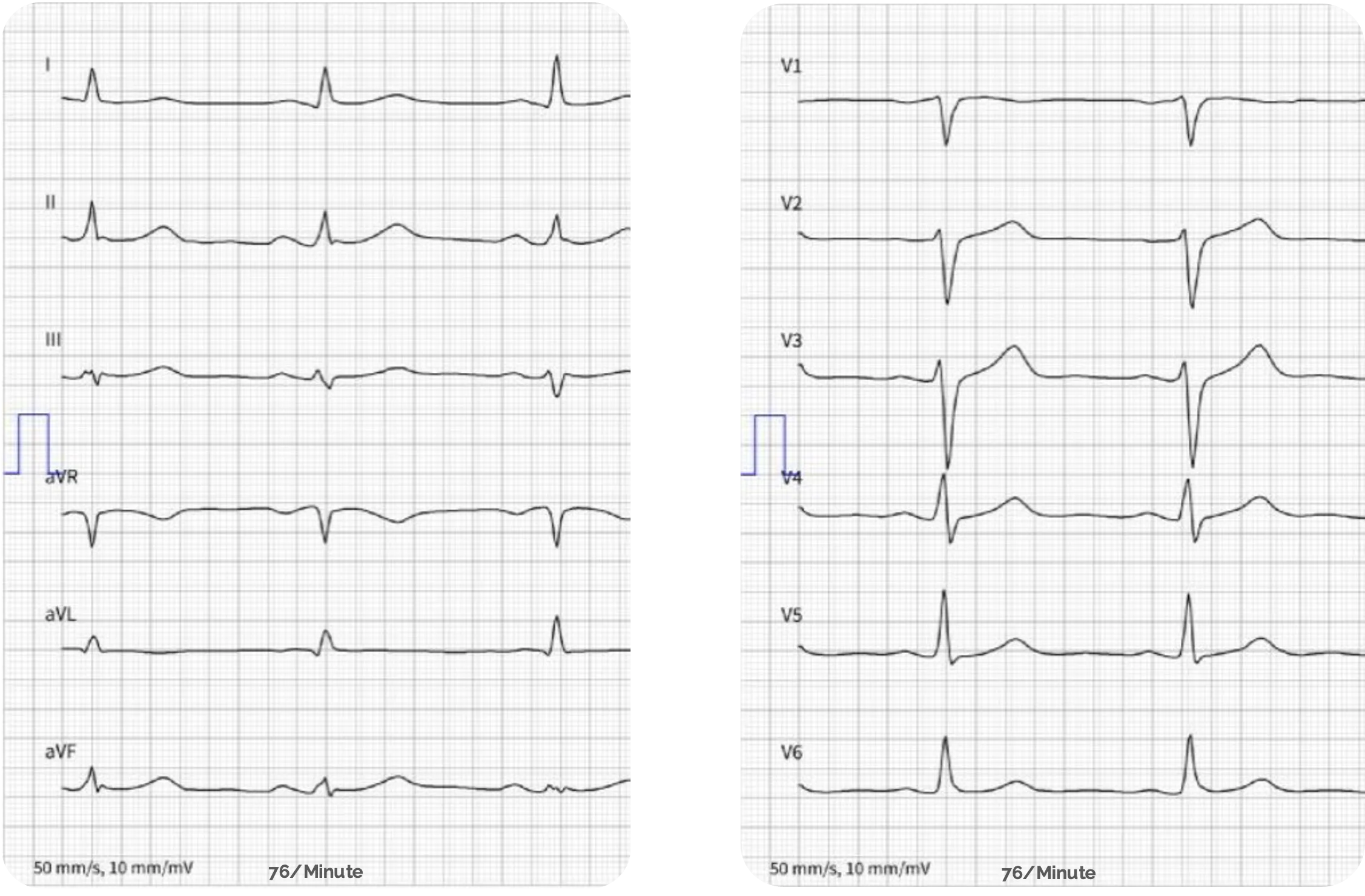 EKG-Papier