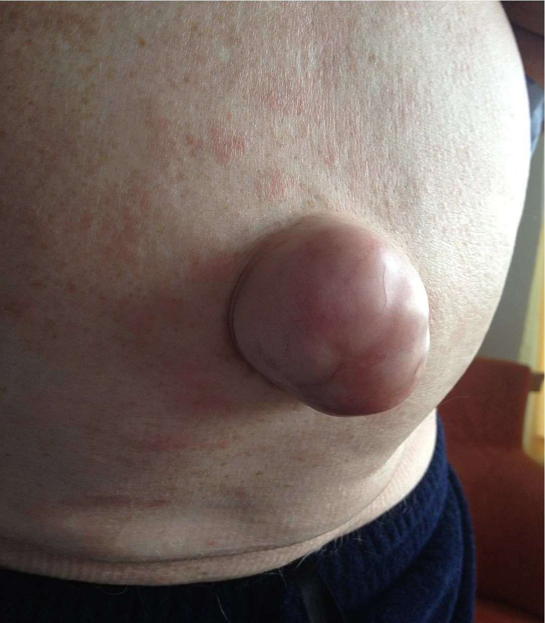 Umbilikalhernie