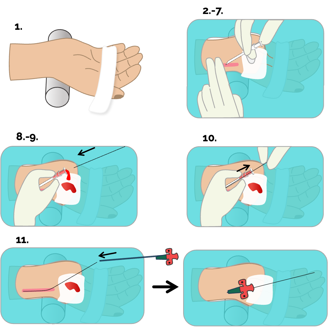 Anlage eines arteriellen Zugangs