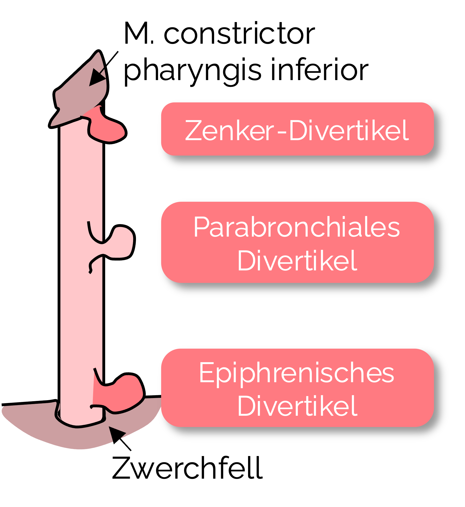 Ösophagusdivertikel