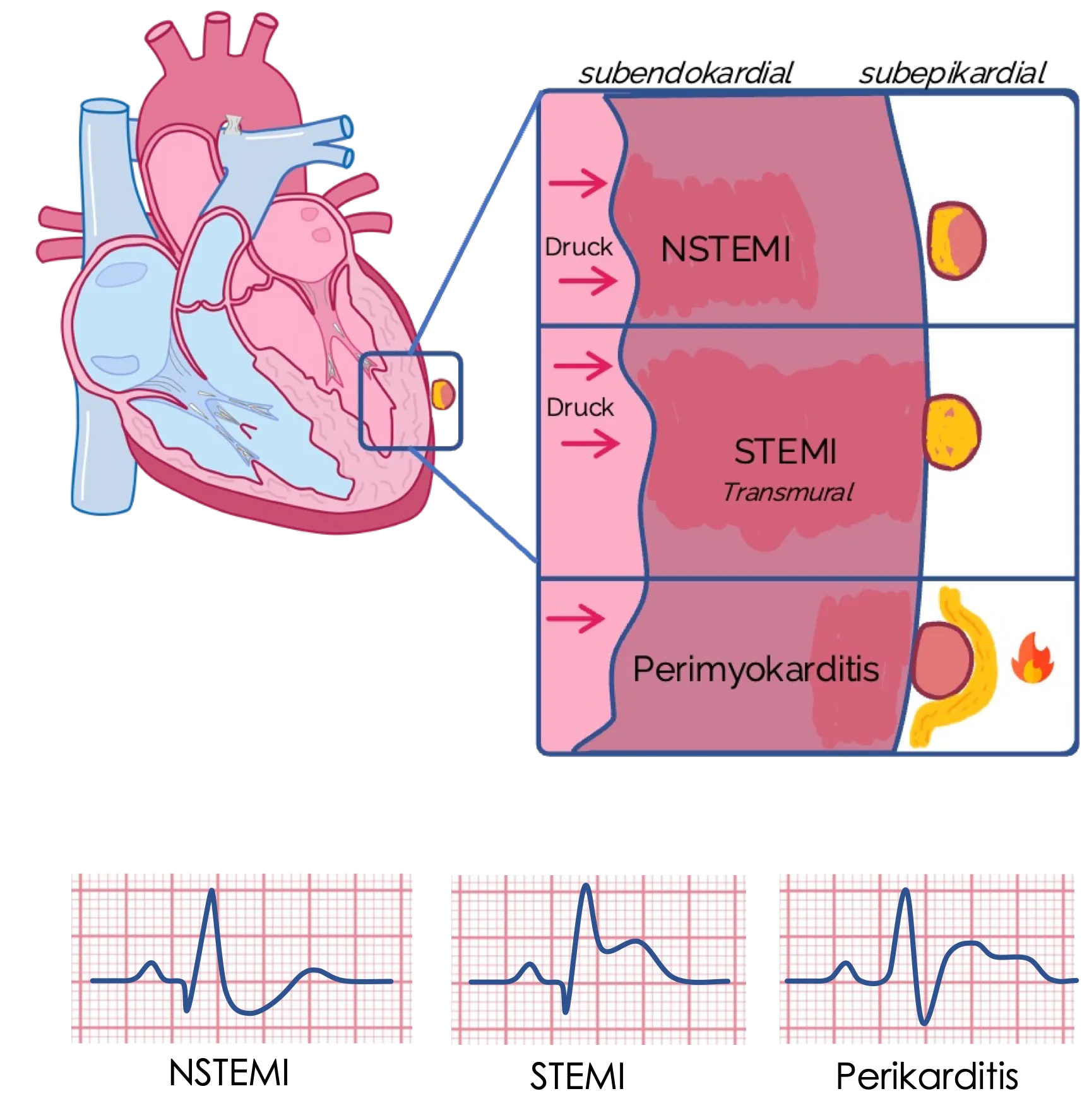 ST-Streckenhebungen Pathophysiologie