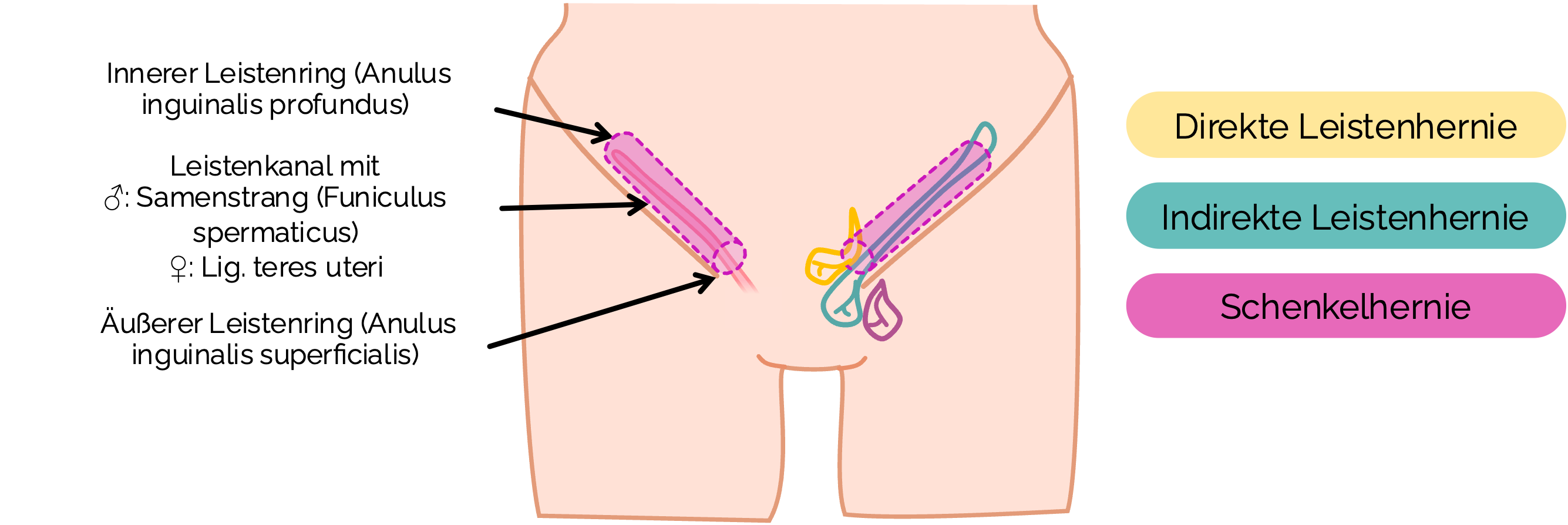 Leistenhernien