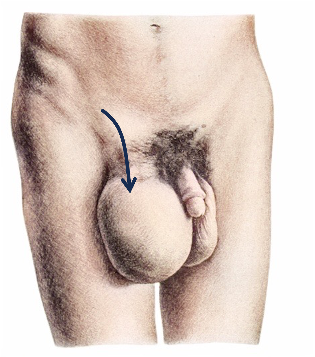 Skrotalhernie