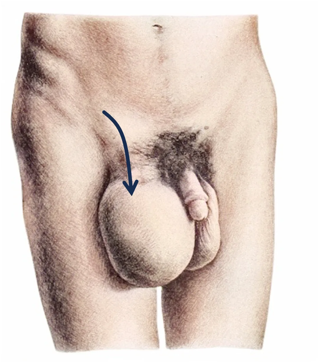 Skrotalhernie