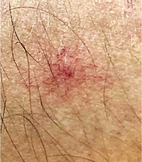 Spider naevus