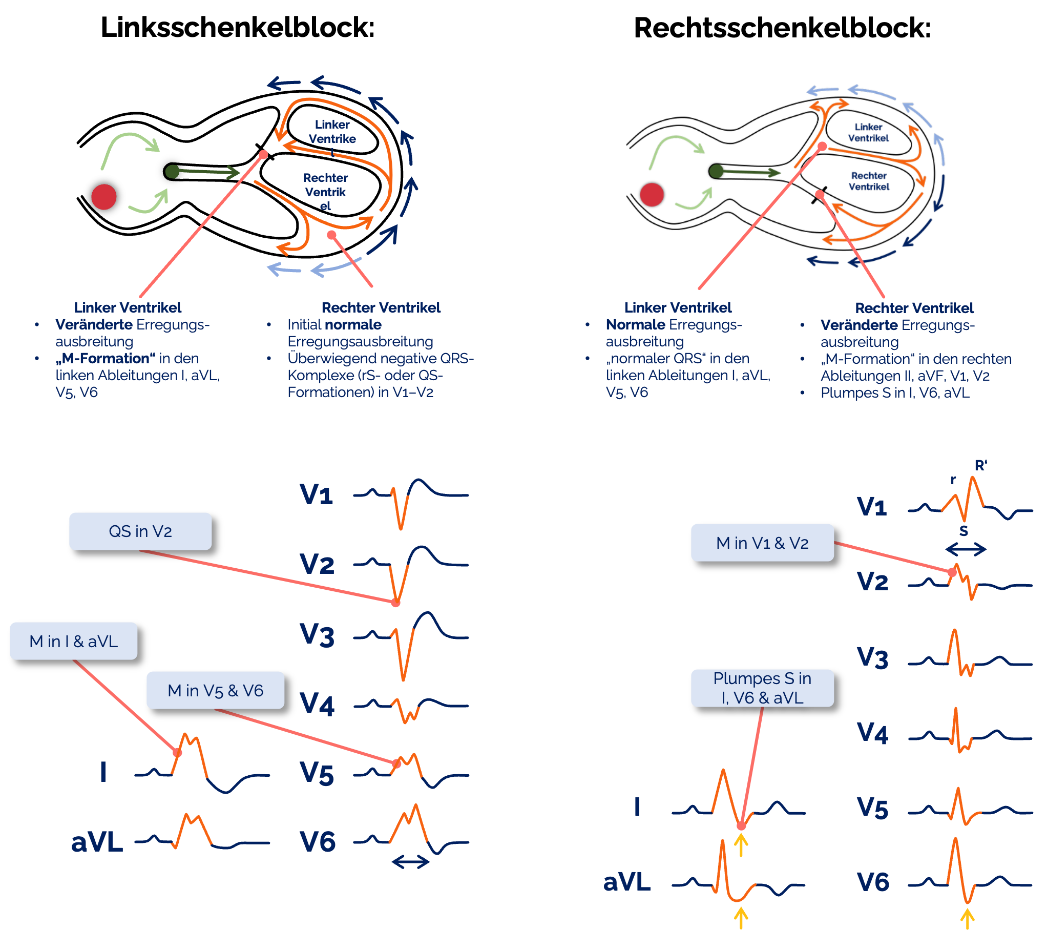 Vergleich Linksschenkelblock und Rechtsschenkelblock