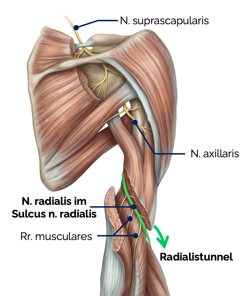 N. radialis im Sulcus nervi radialis